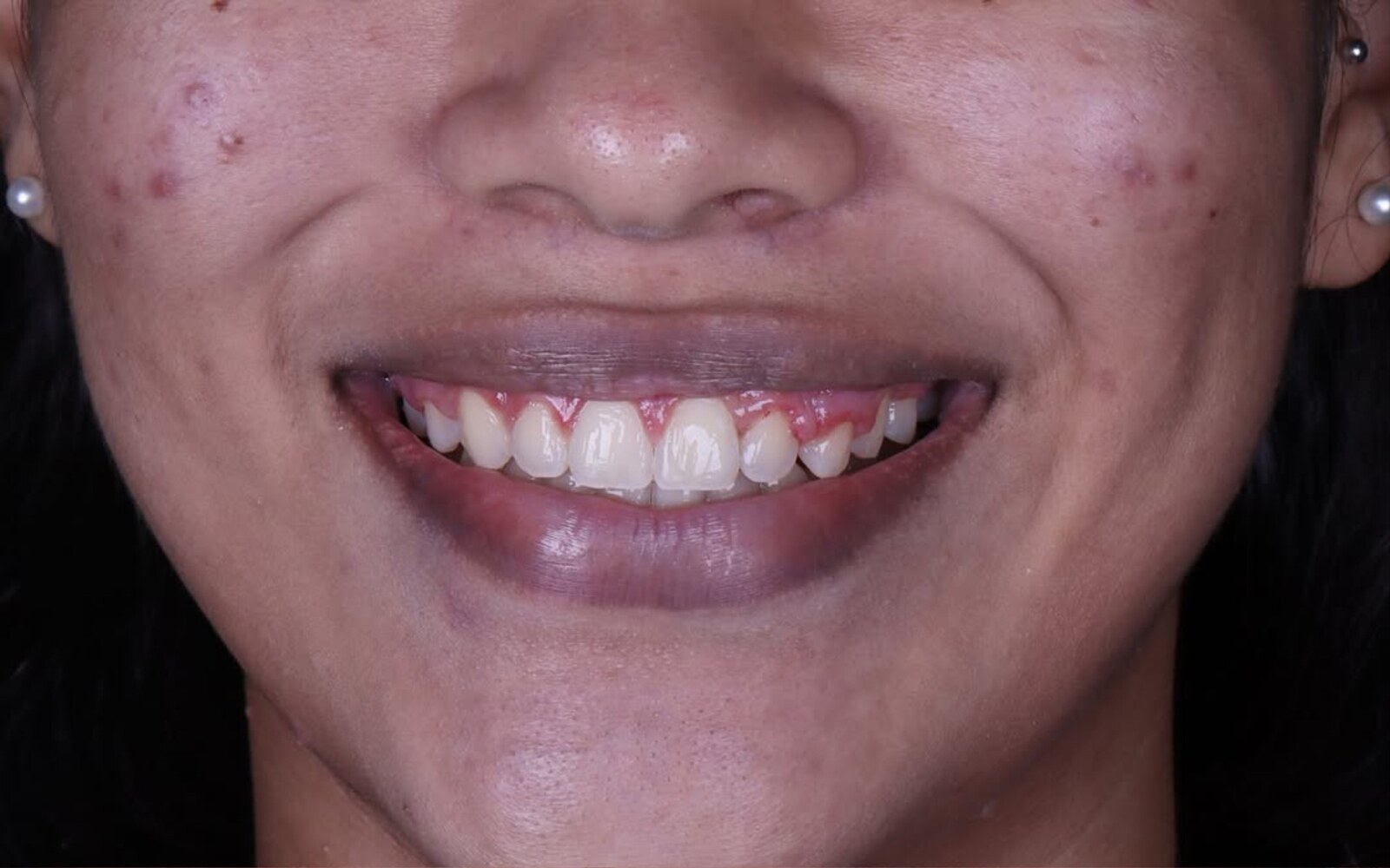 Antes
